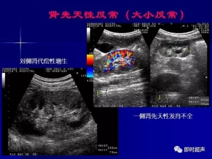 泌尿系统生理病理诊断数据 泌尿系统病超声诊断7