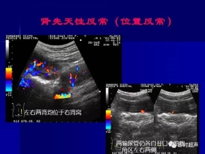 泌尿系统生理病理诊断数据 泌尿系统病超声诊断8