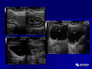 泌尿系统生理病理诊断数据 泌尿系统病超声诊断11