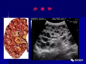 泌尿系统生理病理诊断数据 泌尿系统病超声诊断16