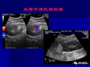 泌尿系统生理病理诊断数据 泌尿系统病超声诊断20