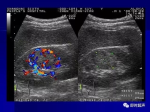 泌尿系统生理病理诊断数据 泌尿系统病超声诊断22