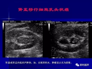 泌尿系统生理病理诊断数据 泌尿系统病超声诊断25