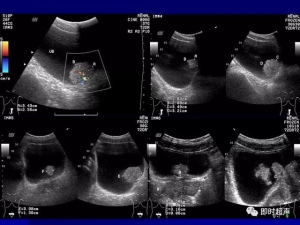 泌尿系统生理病理诊断数据 泌尿系统病超声诊断34