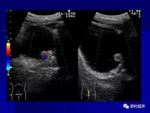 泌尿系统生理病理诊断数据 泌尿系统病超声诊断35