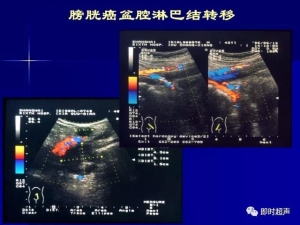 泌尿系统生理病理诊断数据 泌尿系统病超声诊断37