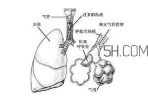 哮喘是如何引起的?哮喘是什么感觉?