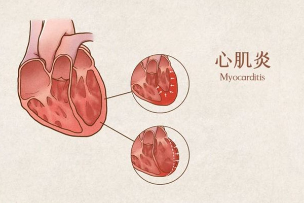 心肌炎早期的症状和前兆 心肌炎有潜伏期吗