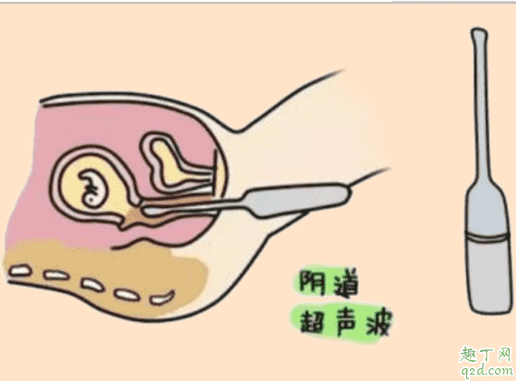 经期前可以做阴超吗 排卵期做阴超会误诊吗3