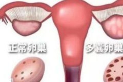 多囊卵巢综合症可以治愈吗？