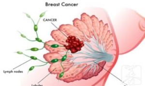 乳腺癌忌口食物有哪些