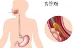 食道癌早期有哪些症状？食道癌早期能治好吗