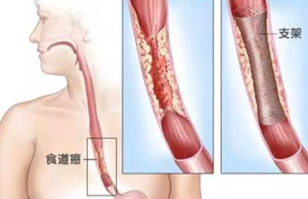 食道癌早期有哪些症状 食道癌早期能治好吗