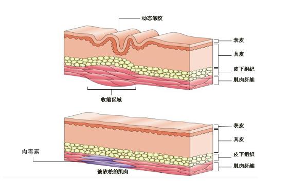 面部皱纹出现的顺序是怎么样的？皱纹的分类