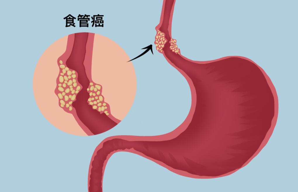 十大最厉害的癌症排行榜